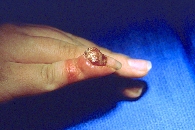 Pyogenic Granuloma Hand Surgery Resource